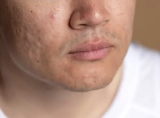 Acne Scar Treatment in Delhi