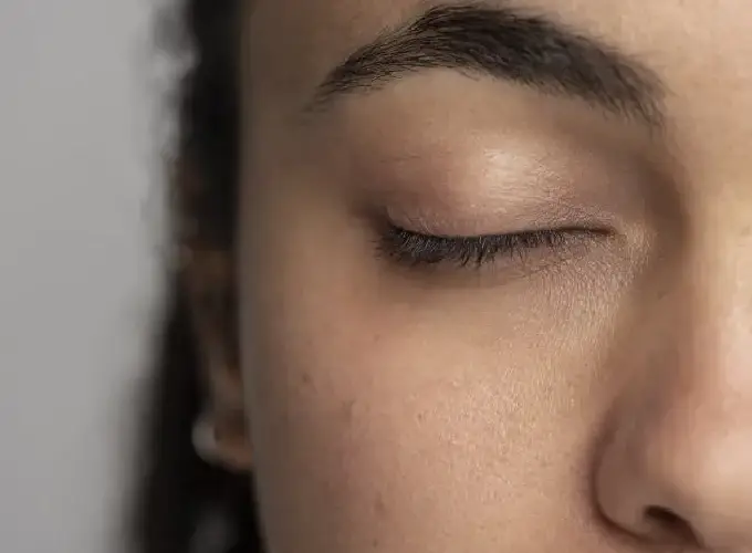 Open Pores Treatment in Delhi
