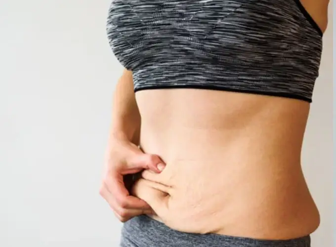 Stretch Marks Treatment in Delhi