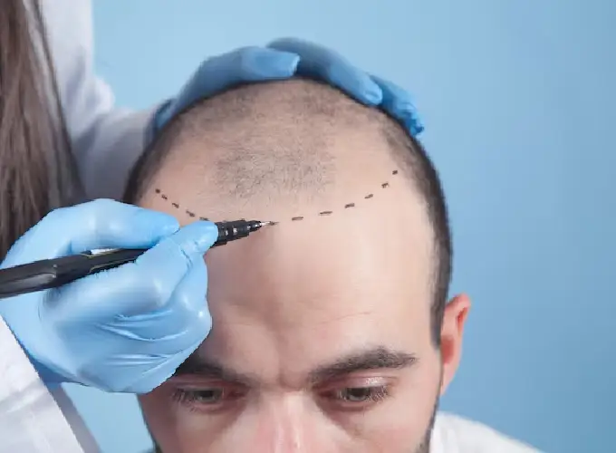 Best Hair Transplant Clinic in Gurgaon