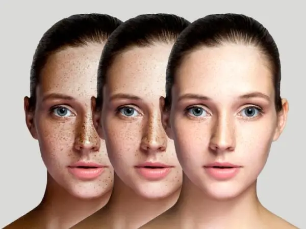 Pigmentation