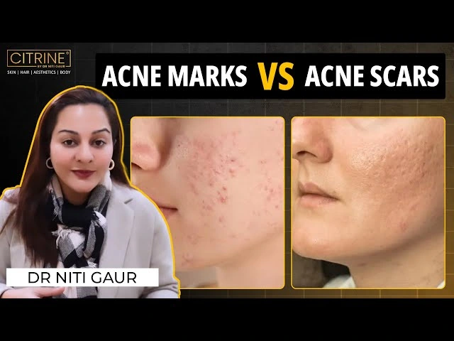 What is Acne Scar Treatment?