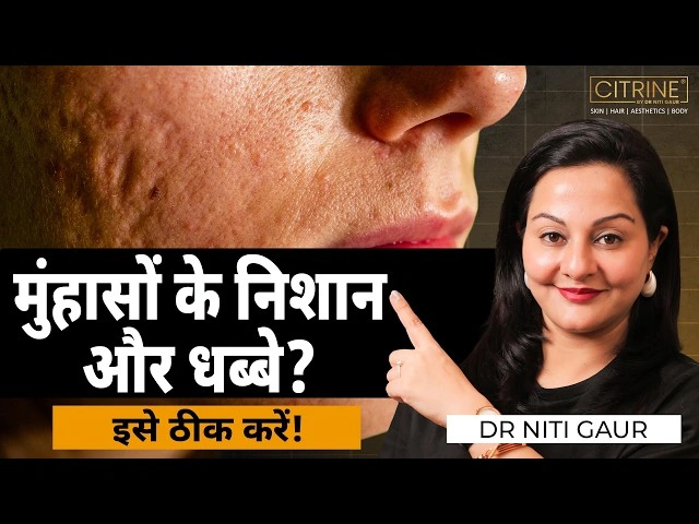 What is Acne?