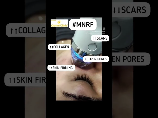 What is Microneedling Treatment?