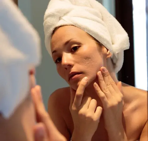 ACNE SCARS