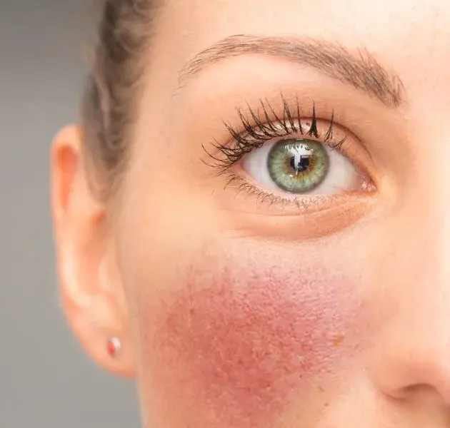 ROSACEA