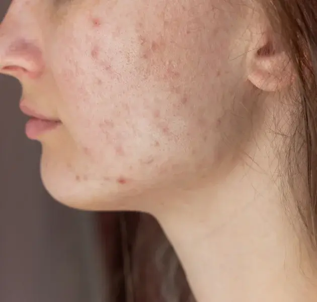 POST-INFLAMMATORY HYPERPIGMENTATION (PIH)