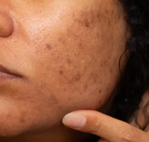 RIEHL'S MELANOSIS