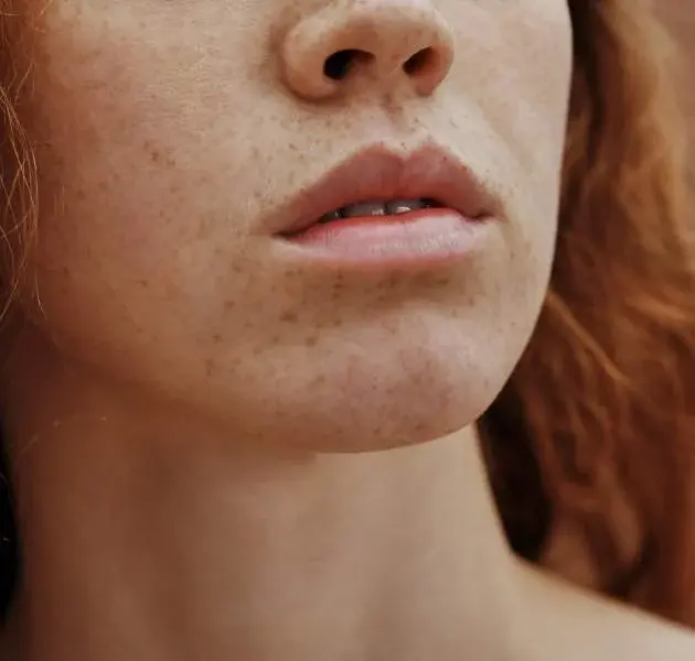 HORI'S NEVUS