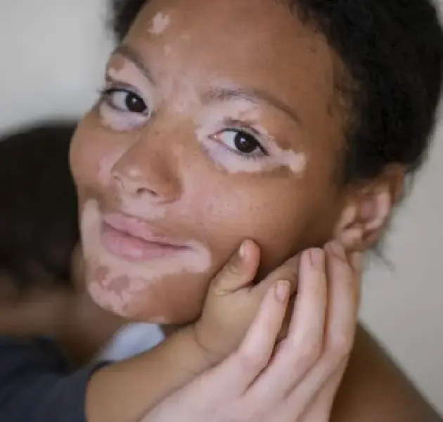 PATCHY PIGMENTATION