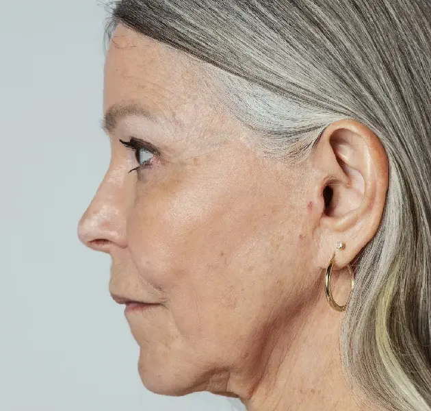 EAR LOBE REPAIR