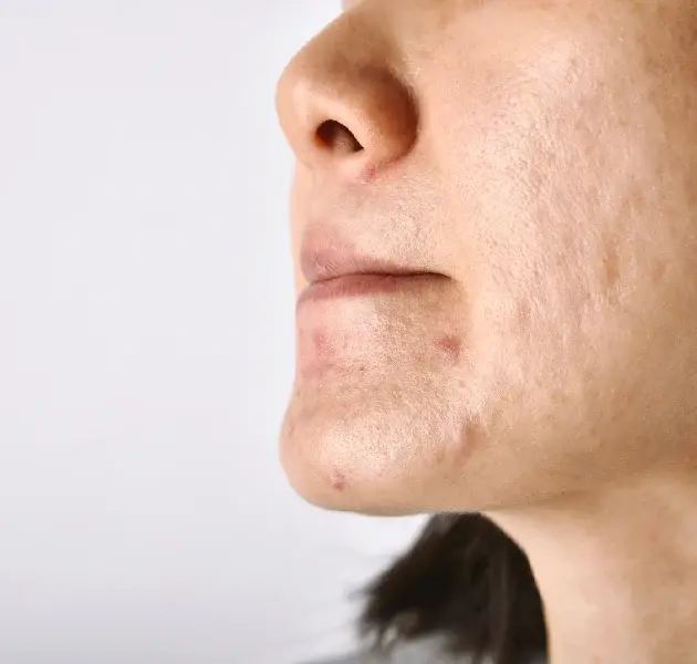 ROUGH SKIN TEXTURE