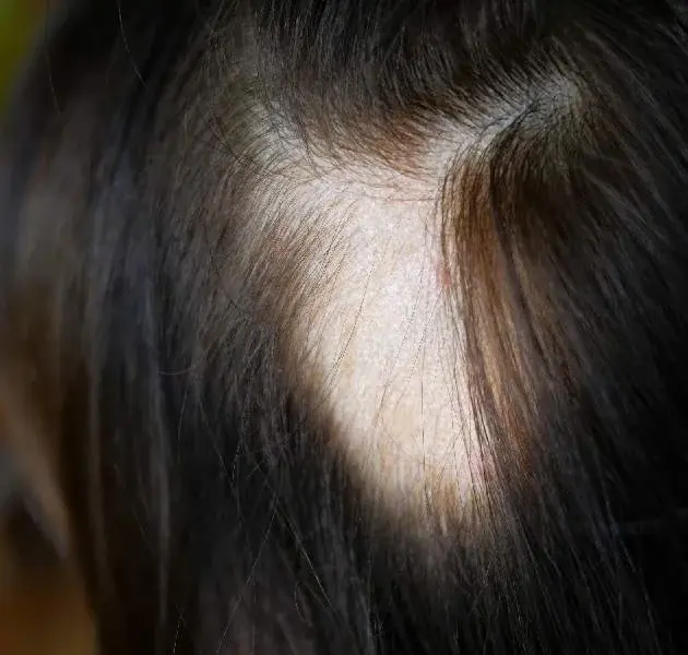ANDROGENETIC ALOPECIA