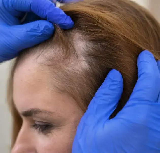 ALOPECIA AREATA