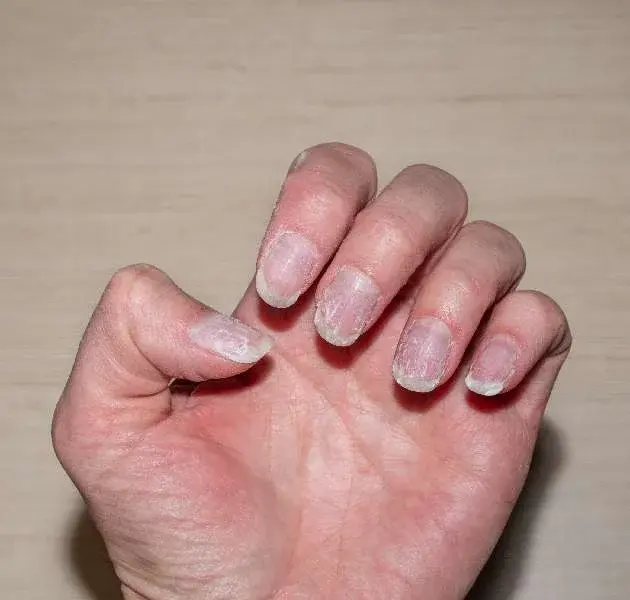 FUNGAL NAIL INFECTION