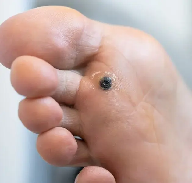 WARTS AND CORNS