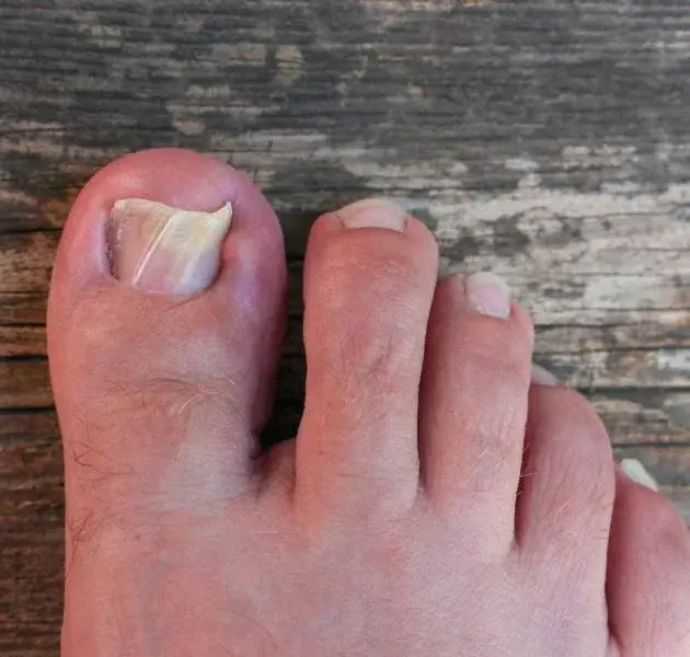 INGROWN TOENAILS